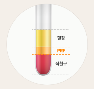 당뇨, 고혈압, 골다공증 대상 임플란트 안내 [ PRF 임플란트 ] [ 강남새로치과 ] 관련 이미지 2