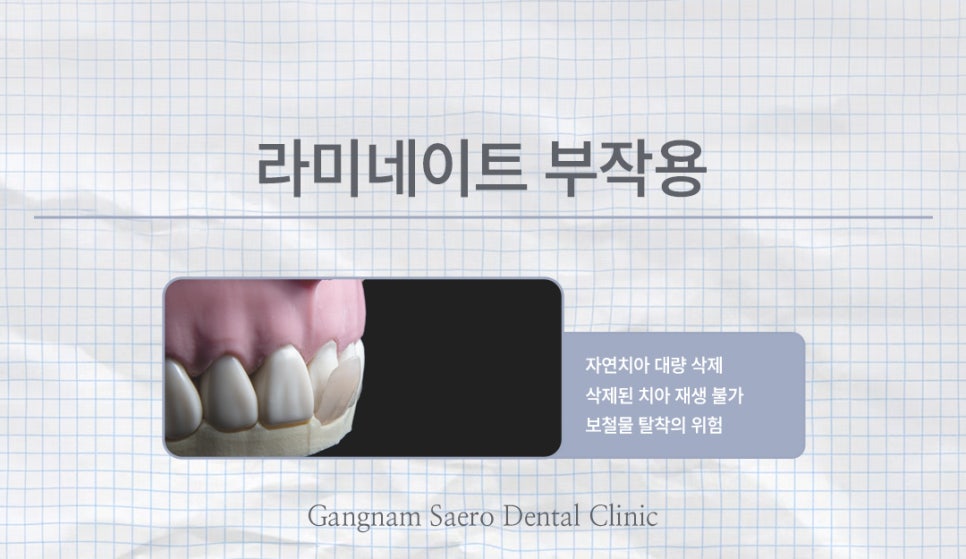 치아 컴플렉스 해결에는 삭제제로라미네이트 에어네이트 (무삭제라미네이트) 관련 이미지 3