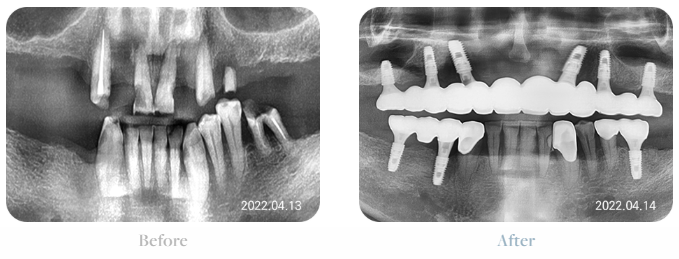 치아가 얼마 안 남은 65세이상임플란트 (전체임플란트후기) 관련 이미지 5