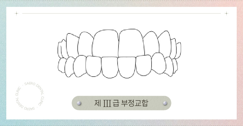 교정 얼굴형 변화 (양악교정 비수술양악) 관련 이미지 4