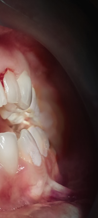 치은염 증상 어떠한 문제들이 있을까요? 관련 이미지 10