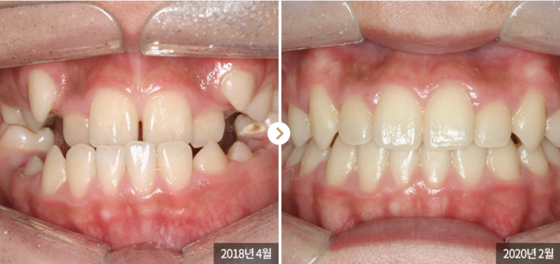 송곳니덧니교정을 발치 문제 없이 진행할 수 있다면? 관련 이미지 2