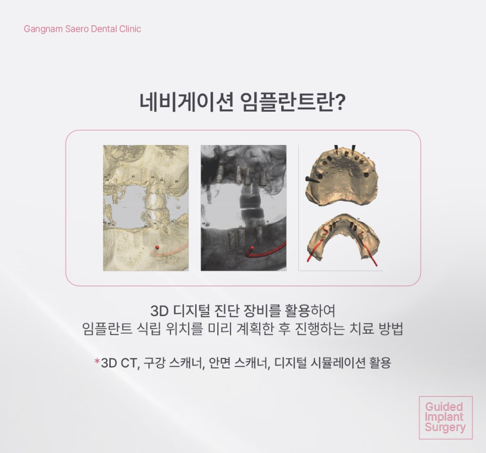 Implants with Less Swelling and Pain Burden (Navigation-Guided Implants) image 2
