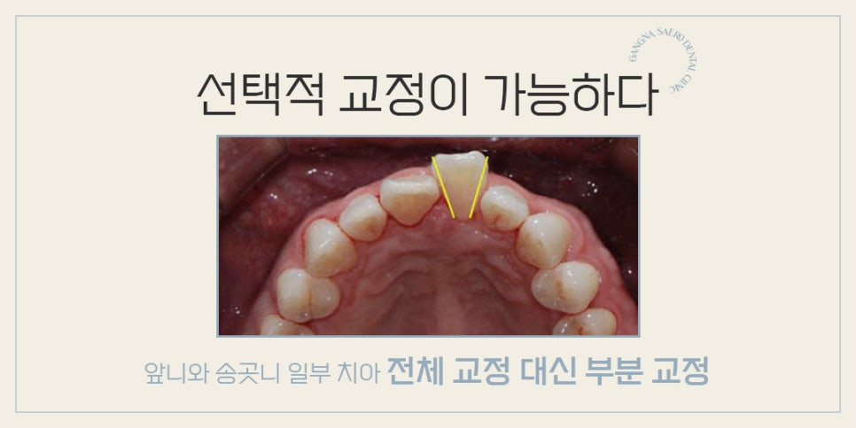 4개월이면 치료 종료되는 급속교정 (강남역부분교정) 관련 이미지 7
