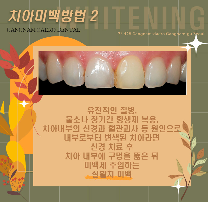 치아미백방법 치아미백비교 치아미백전후 (에어네이트, 전문가미백, 자가미백) 관련 이미지 3