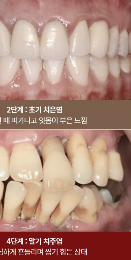 치은염 증상 어떠한 문제들이 있을까요? 관련 이미지 3