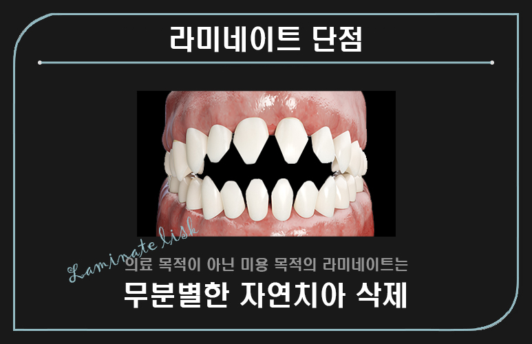 에어네이트의 특별함 (라미네이트 대체 시술) 관련 이미지 2