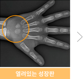 유아 주걱턱교정, 올바른 뼈 성장을 위한 방법 관련 이미지 12