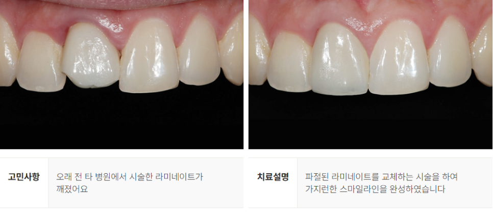 강남역 무삭제 라미네이트 (에어네이트) 관련 이미지 9