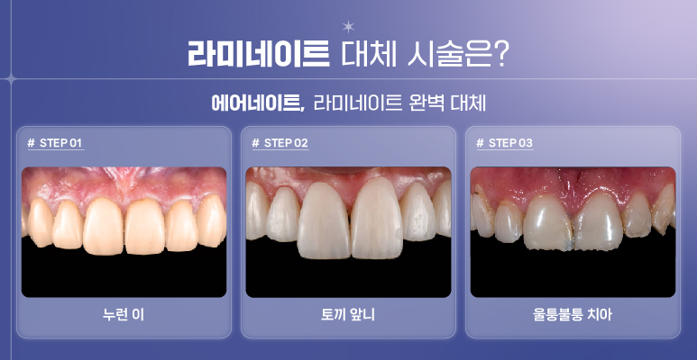 강남역 라미네이트대체 시술 (에어네이트) 관련 이미지 5