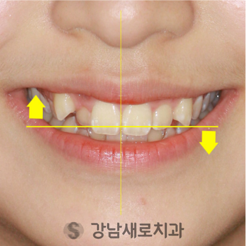 송곳니덧니교정, 방치하면 부작용이 발생한다? 관련 이미지 8