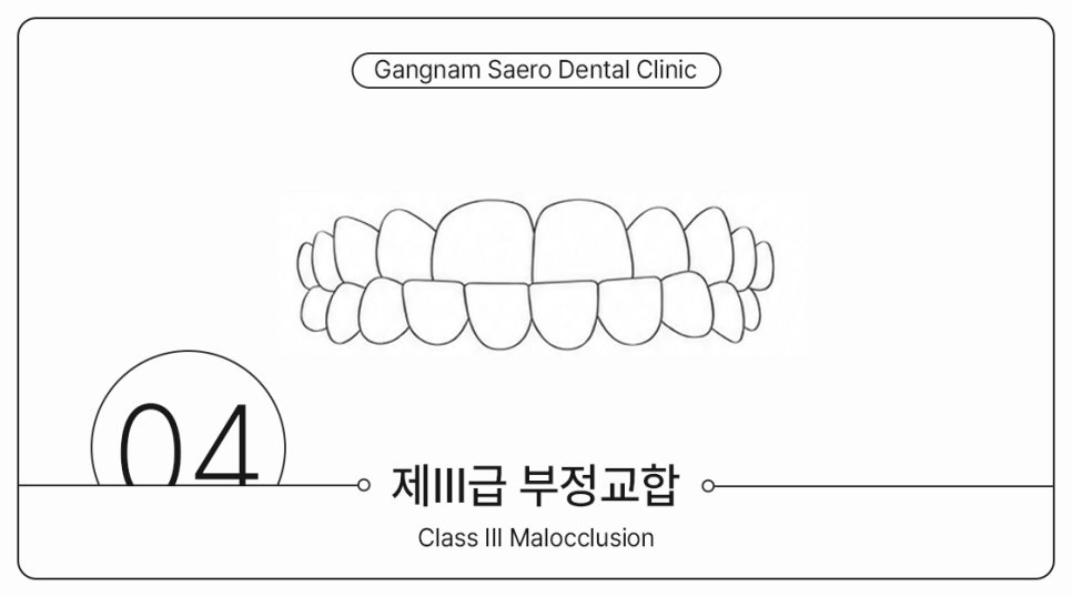 부정교합 개방교합 과개교합 투명교정으로 가능할까요? (주걱턱교정기 돌출입교정기) 관련 이미지 6