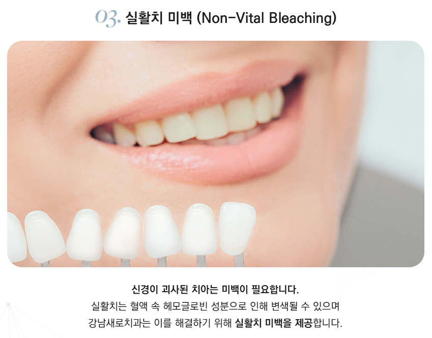 치과미백 vs 자가미백 vs 라미네이트, 치아미백방법 비교 관련 이미지 5