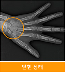 유아 주걱턱교정, 올바른 뼈 성장을 위한 방법 관련 이미지 14