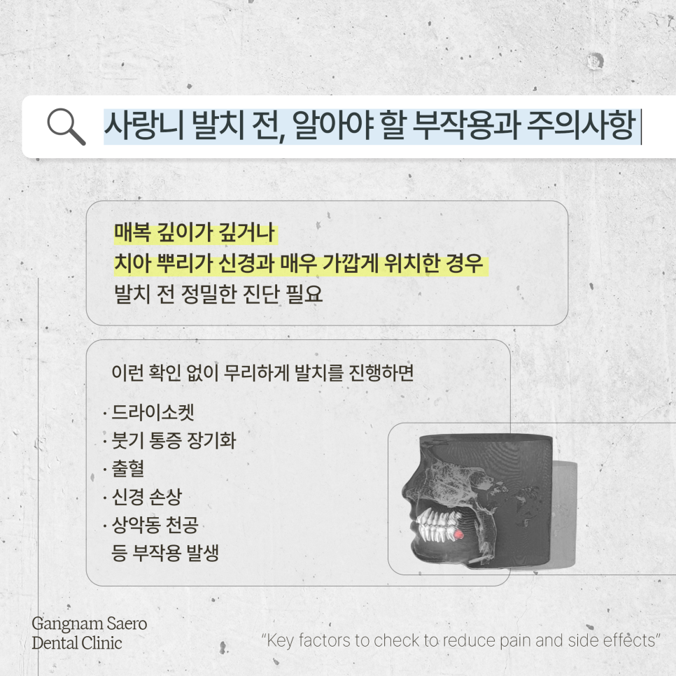 (사랑니발치) 통증과 부작용을 줄이기 위해 확인해야 할 것들 관련 이미지 3