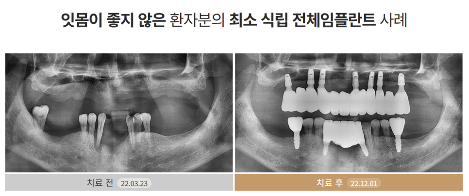 65세이상임플란트 (전체임플란트전후) 관련 이미지 6