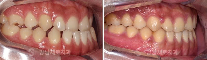 어린이주걱턱교정, 성장기전 빠른 시일내에 진행해야 하는 이유? 관련 이미지 5