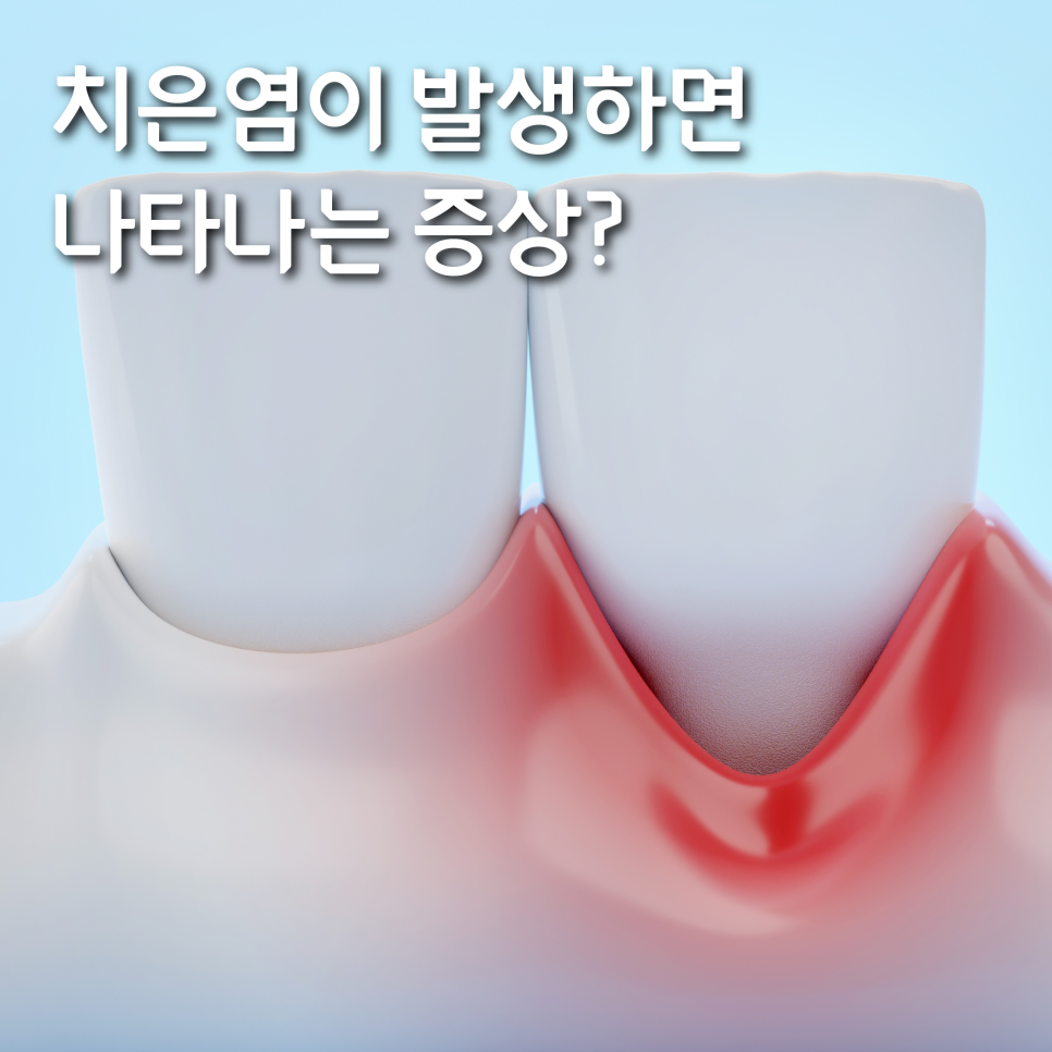 치은염 증상 어떠한 문제들이 있을까요? 관련 이미지 4