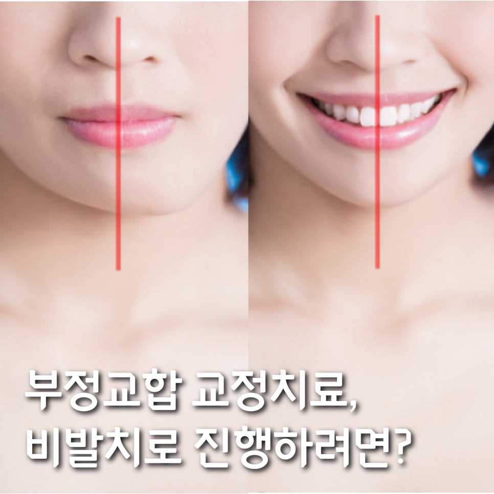 부정교합 교정치료, 비발치로 진행하려면? 관련 이미지 1