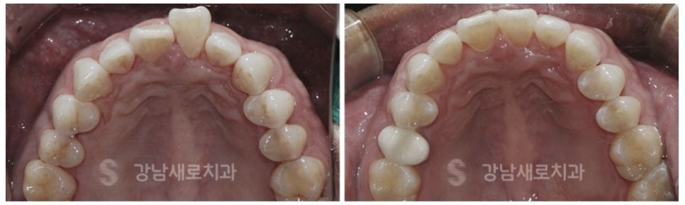4개월만에 끝나는 부분교정 (급속교정후기) 관련 이미지 5