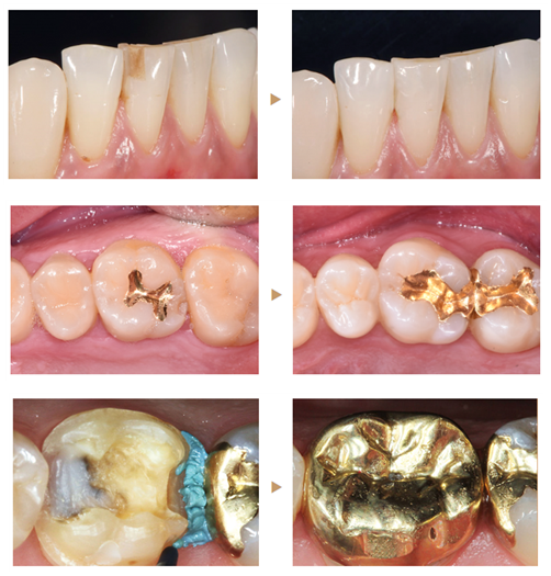 양심치과가 말해주는 충치 치료 종류와 비용 [ 강남새로치과 ] 관련 이미지 9