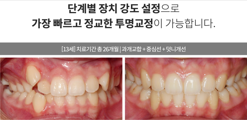 송곳니덧니교정을 발치 문제 없이 진행할 수 있다면? 관련 이미지 4