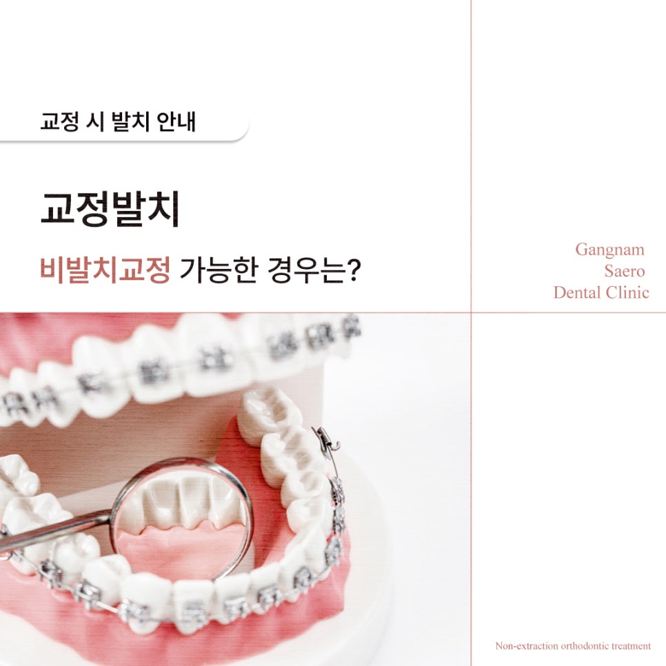 Tooth Extraction During Orthodontic Treatment: When Is Non-Extraction Orthodontic Treatment Possible? (Orthodontic Extraction) image 1