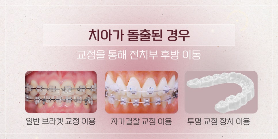 웃을 때 잇몸이 많이 보여요 (잇몸성형 돌출입 교정) 관련 이미지 5