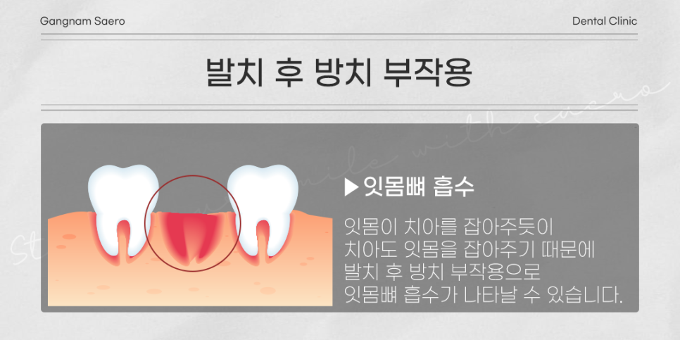 발치 후 꼭 임플란트 해야 하나요? (임플란트안하면) 관련 이미지 2