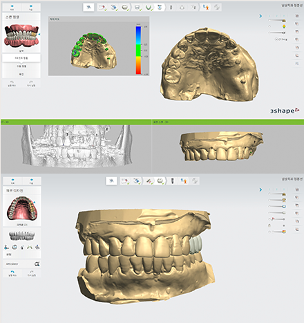 임플란트 일상 회복이 걱정된다면 (네비게이션임플란트) 관련 이미지 2