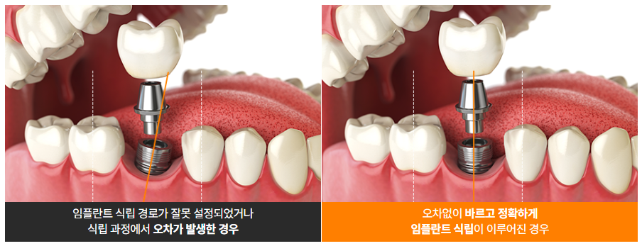 임플란트 영구적이 아닌가요? (임플란트수명) 관련 이미지 7