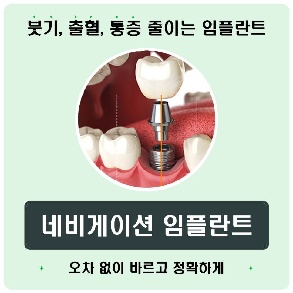 오차 줄이는 네비게이션임플란트 (붓기, 출혈, 통증 줄이는 임플란트) 관련 이미지 1