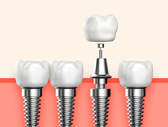 임플란트 부작용 자세히 알아보기(1) 임플란트 보철 (크라운, 지대주, 픽스쳐) 부작용 [ 예방 및 대처 방법 ] [ 강남새로치과 ] 관련 이미지 7