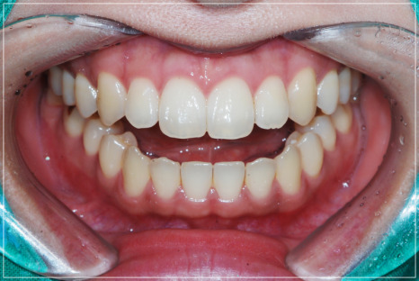 입안다물어짐 비수술로 해결이 가능하다면 관련 이미지 10