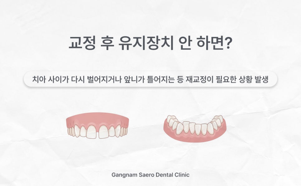 교정 후 유지장치 꼭 해야 할까요? (유지장치기간 유지기기간) 관련 이미지 3