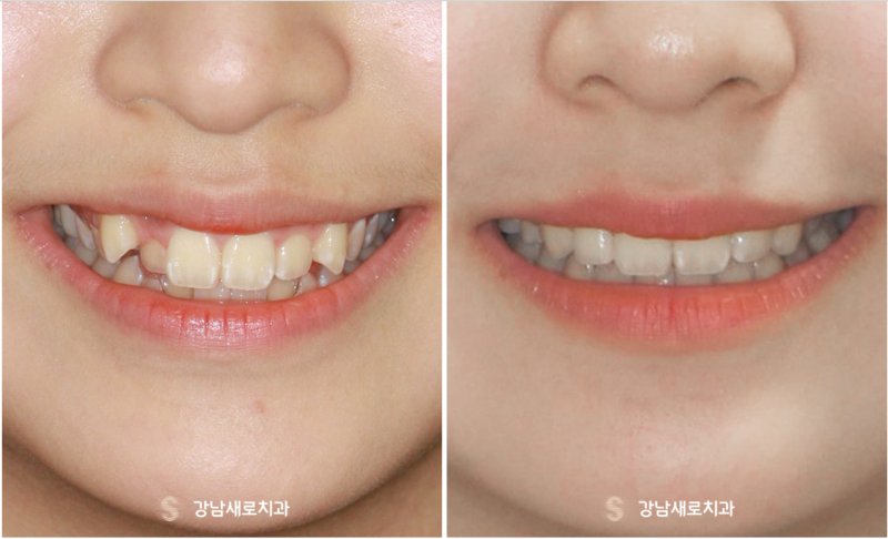 송곳니덧니교정을 발치 문제 없이 진행할 수 있다면? 관련 이미지 11