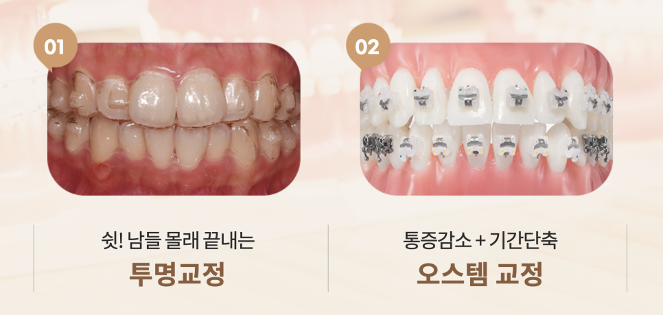 비발치교정치료, 부작용 피하는 방법? 관련 이미지 11