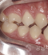 양악전 교정과 양악후 교정, 진행 방법의 차이를 알아보자. 관련 이미지 8