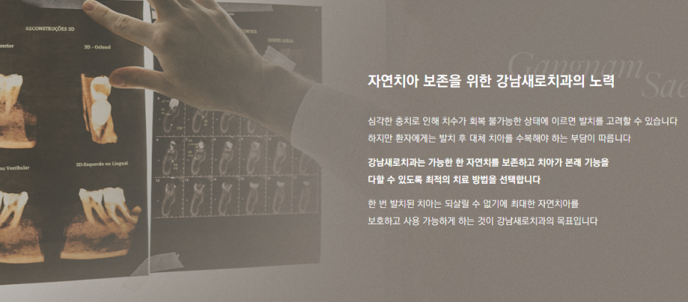 치아크랙 치아벌어짐 치아파절 회복하는 방법 (치아레진) 관련 이미지 7