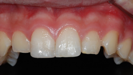 법랑질 삭제를 최소로 하는 헨리라미네이트 관련 이미지 11