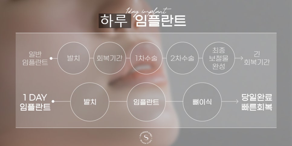발치부터 임플란트까지 최대 6개월 단축 (하루임플란트) 관련 이미지 3