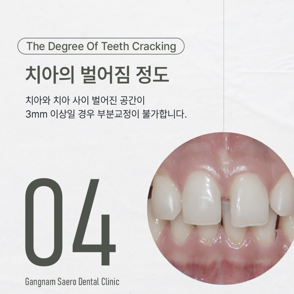 앞니만 교정하고 싶다면 부분만 교정하는 (앞니교정) 관련 이미지 5