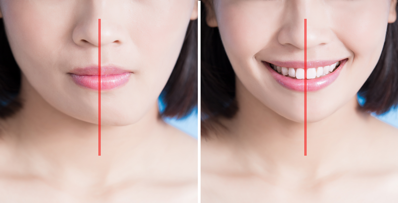 치아교정 중단, 멈추면 문제가 생길 수 있어요. 치료 중단 시 발생하는 문제, 어떤 상태가 되는지 알아볼게요. 관련 이미지 4