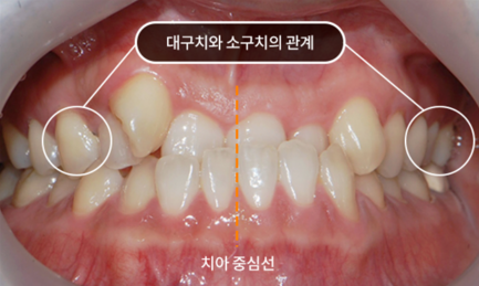 비수술 주걱턱 교정 (양악수술 대신 교정이 가능할까요?) [ 강남새로치과 ] 관련 이미지 5