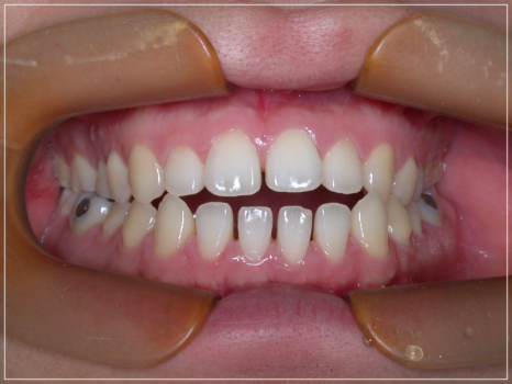 입안다물어짐 비수술로 해결이 가능하다면 관련 이미지 4