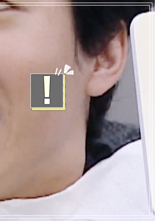 헨리라미네이트, 치아 손상없이 안전하게 진행 관련 이미지 3