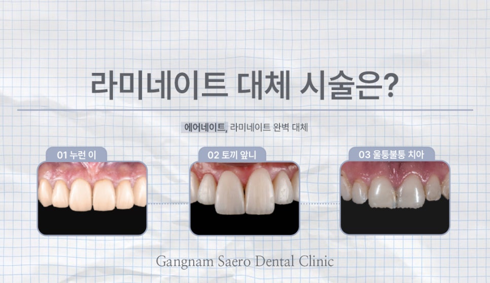치아 컴플렉스 해결에는 삭제제로라미네이트 에어네이트 (무삭제라미네이트) 관련 이미지 5