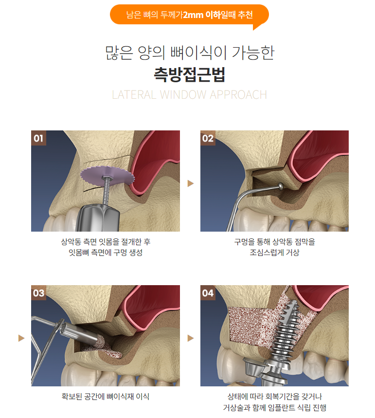 안전한 윗니 임플란트 (상악동거상술) 관련 이미지 2