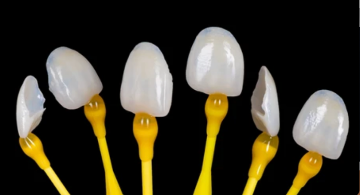 연예인라미네이트, 강남새로치과 에어네이트 관련 이미지 1