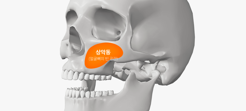 윗니 임플란트 안정성 높이는 강남새로치과 핵심 술식 （상악동거상술） 관련 이미지 1